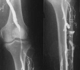 Възможности за диагностика на разширени вени на крайниците