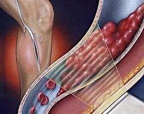 разширени вени на дълбоките вени на долните крайници